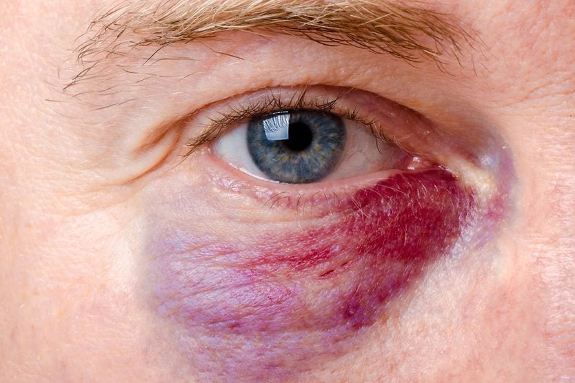 closeup of a black eye