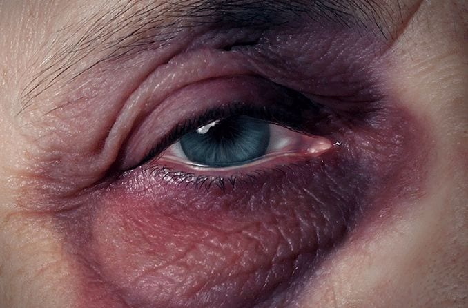 Black eyes: Causes, treatment and prevention