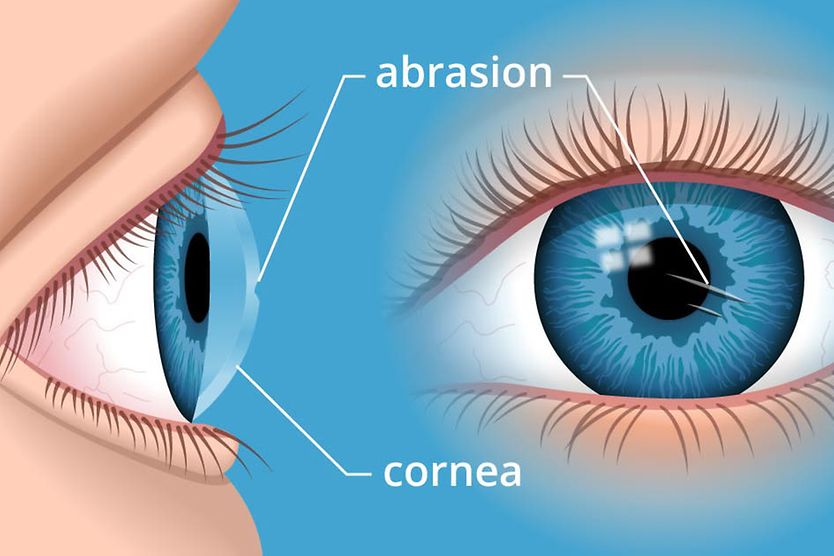 Illustration of a corneal abrasion Illustration of a corneal abrasion