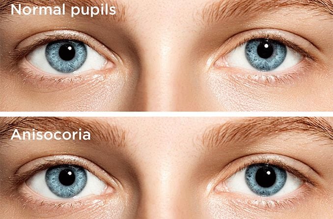 Adie’s pupil: Causes, symptoms and treatments Adie’s pupil: Causes, symptoms and treatments