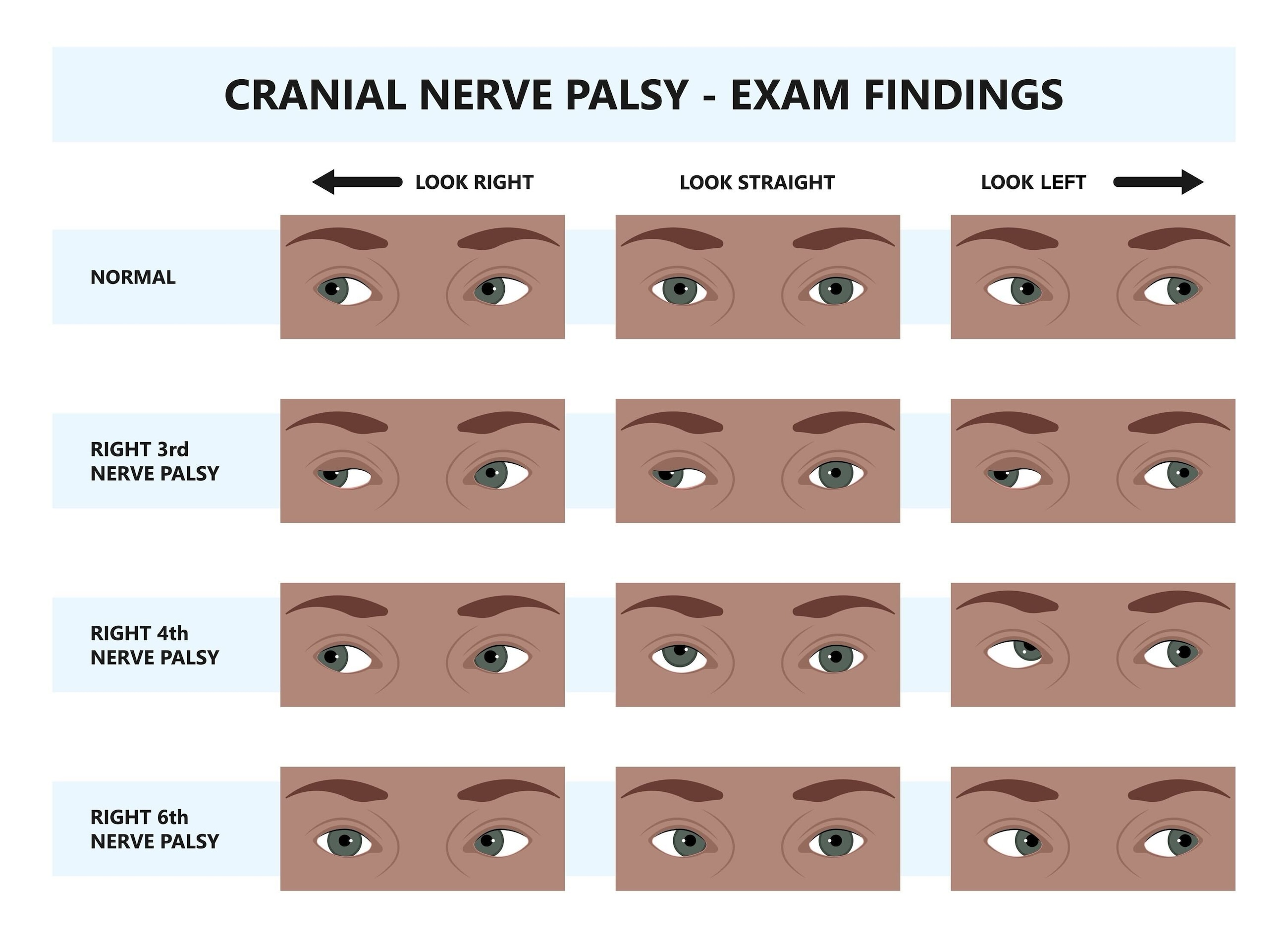 Cranial nerve palsy exam findings examples