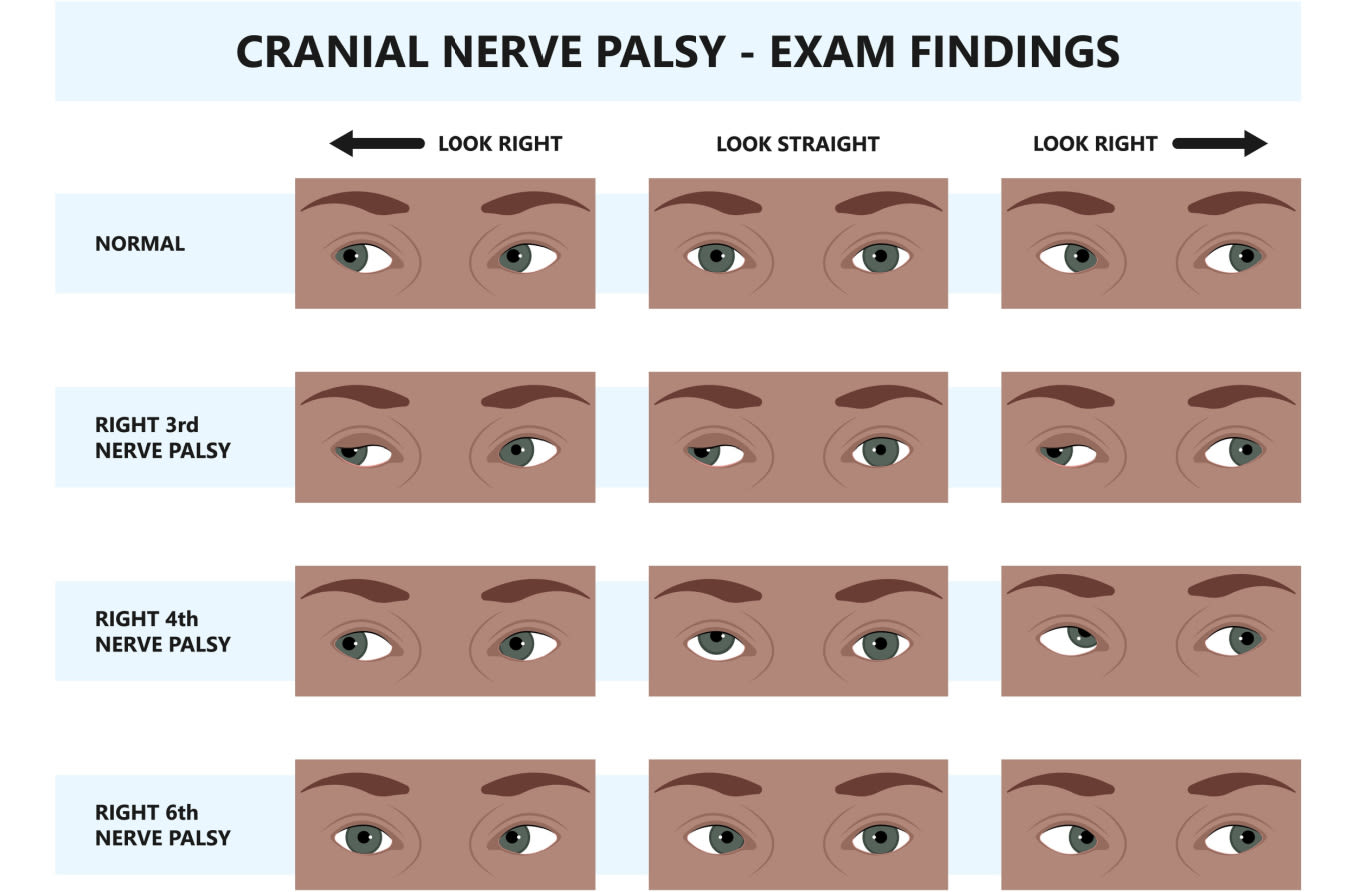 Cranial nerve palsy – CN III, IV, VI & VII palsy