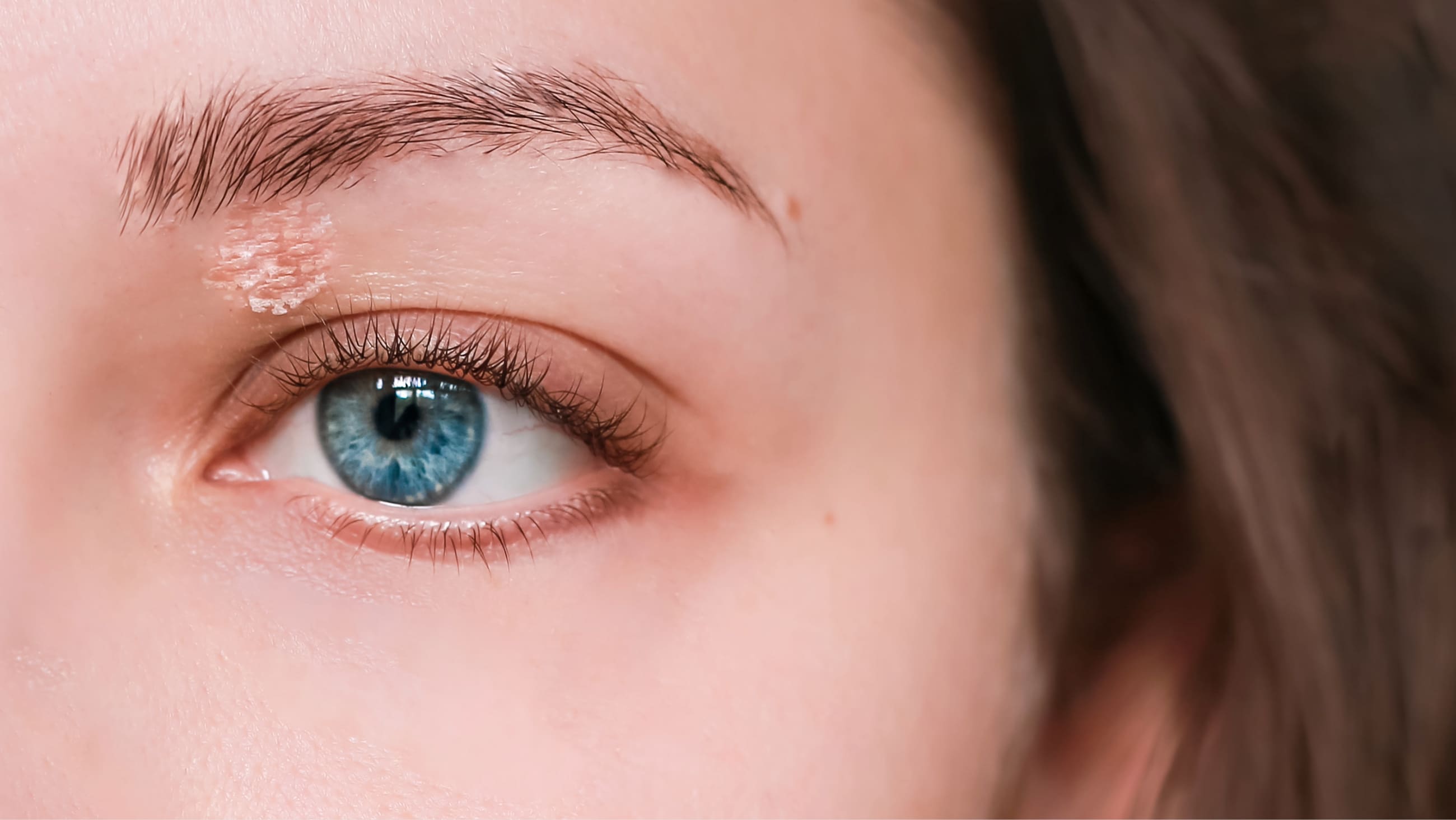 Eyelid Psoriasis