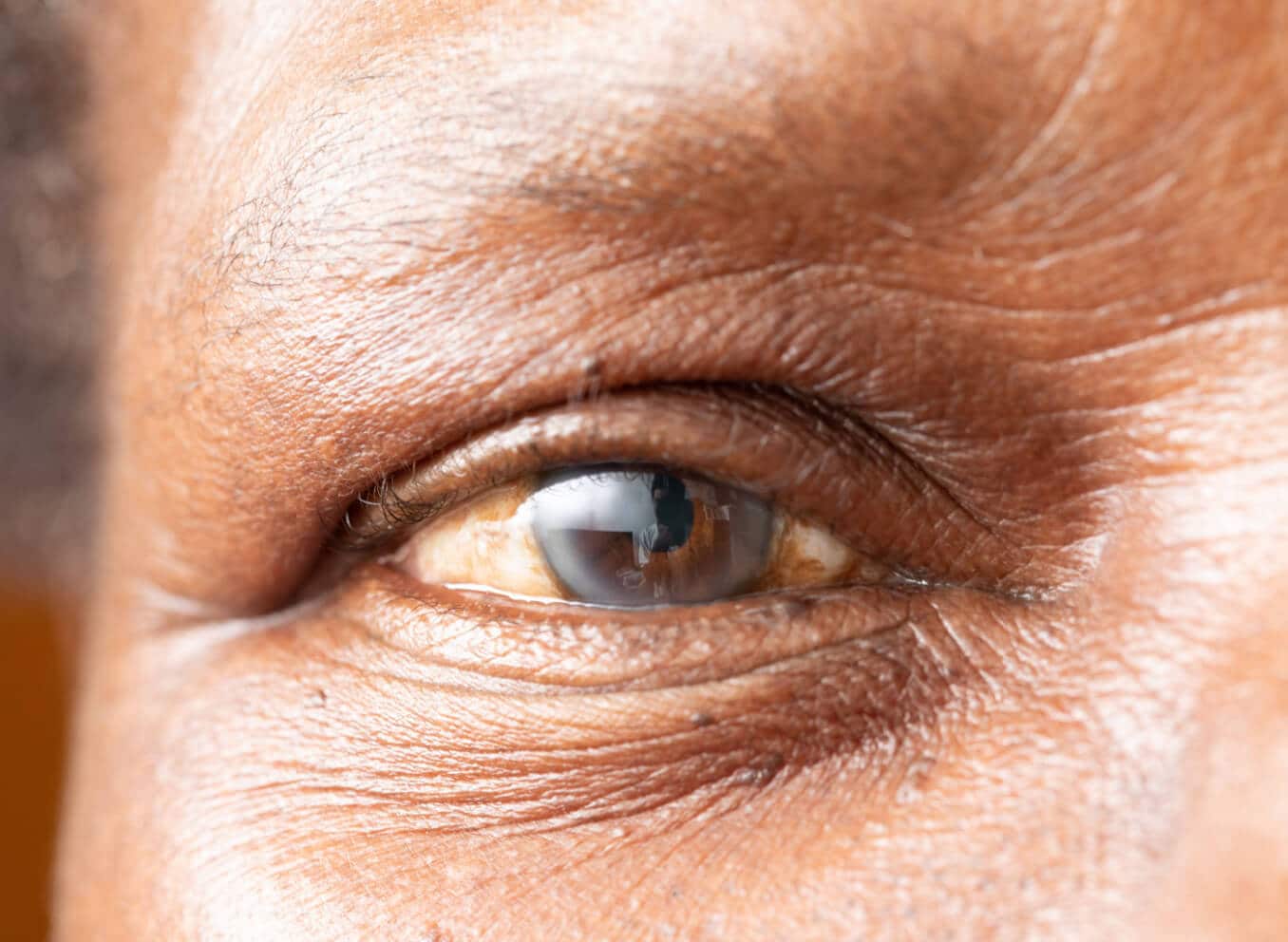 Intraoperative floppy iris syndrome (IFIS): Causes, characteristics and treatment Intraoperative floppy iris syndrome (IFIS): Causes, characteristics and treatment
