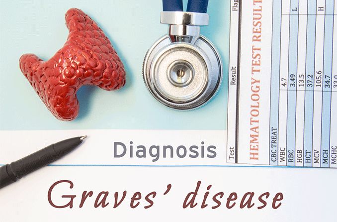 Graves’ disease and how it can affect the eyes