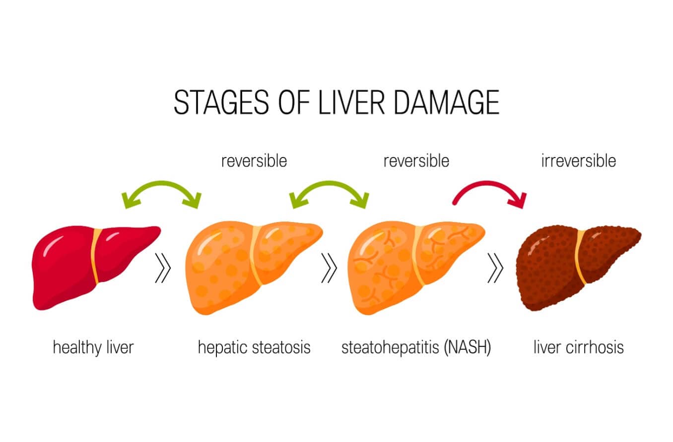 How does liver failure affect your eyes?