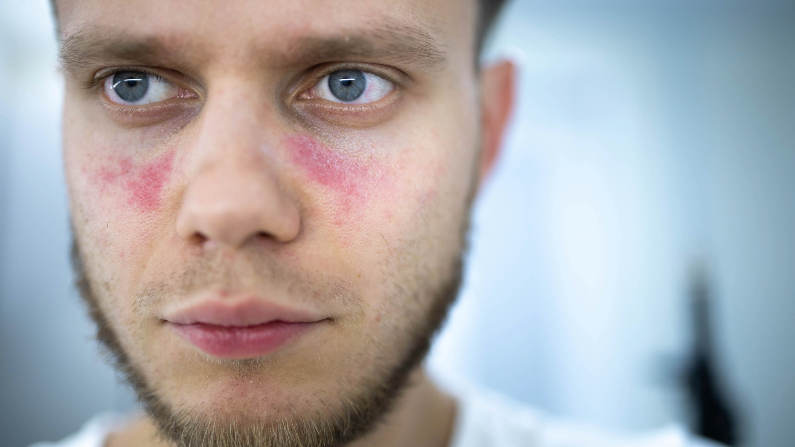 Five ways lupus can affect eyes and vision health Five ways lupus can affect eyes and vision health