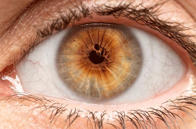 Polycoria causes, symptoms and treatments Polycoria causes, symptoms and treatments