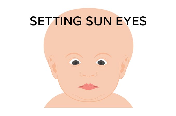 Setting sun eye phenomenon in infants