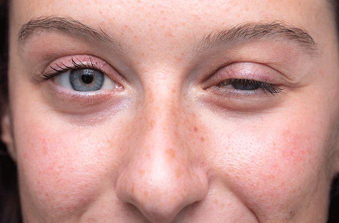 Ocular myasthenia gravis: Symptoms, treatment and pictures