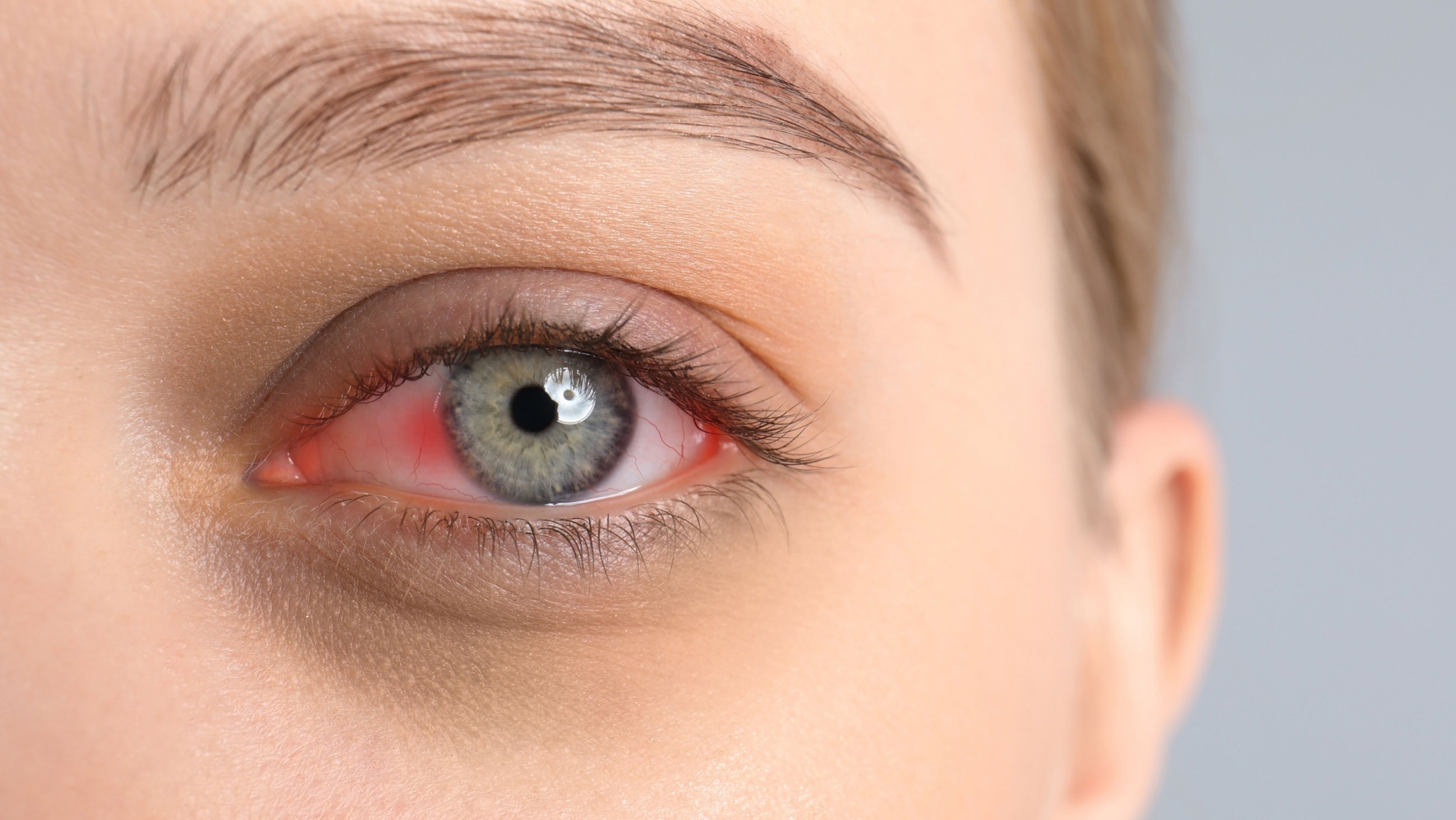 woman with pink eye woman with pink eye