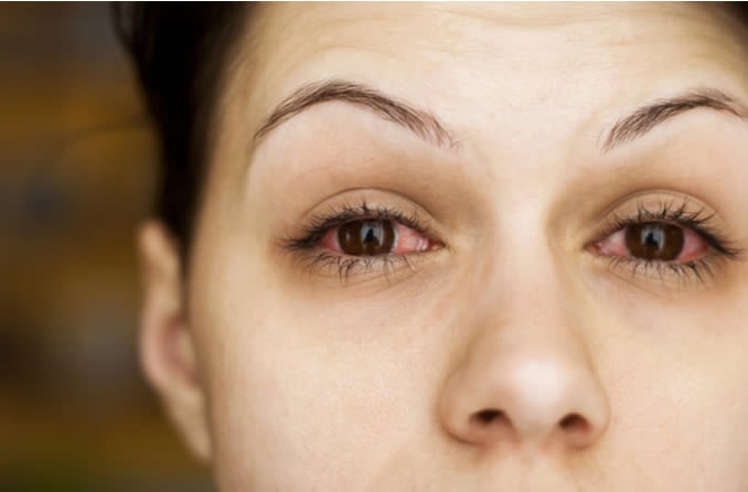 Is pink eye a symptom of COVID-19, a cold or the flu?