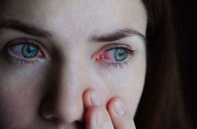 Coronavirus (COVID-19) eye symptoms