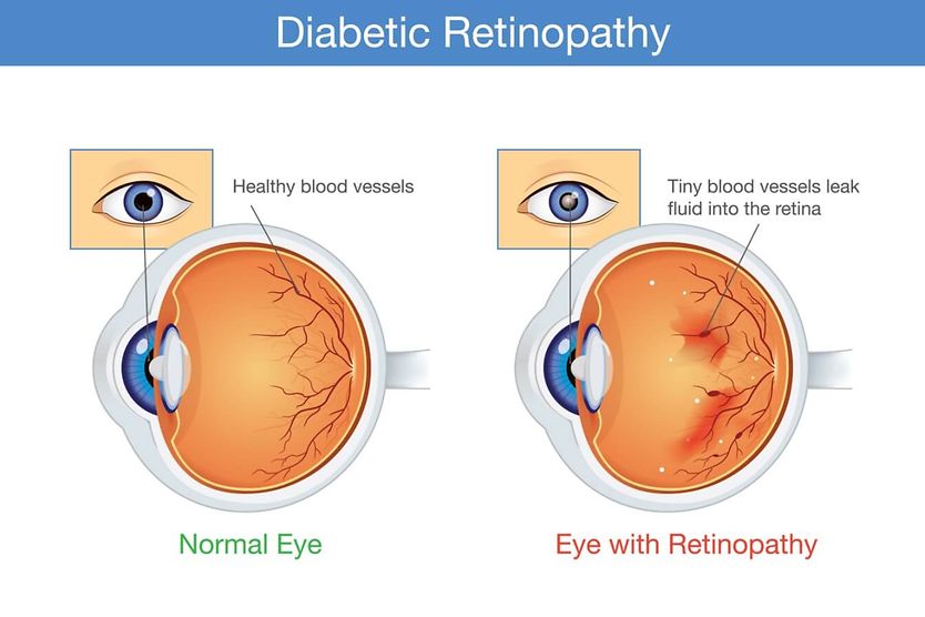 Medical illustration of diabetic retinopathy.
