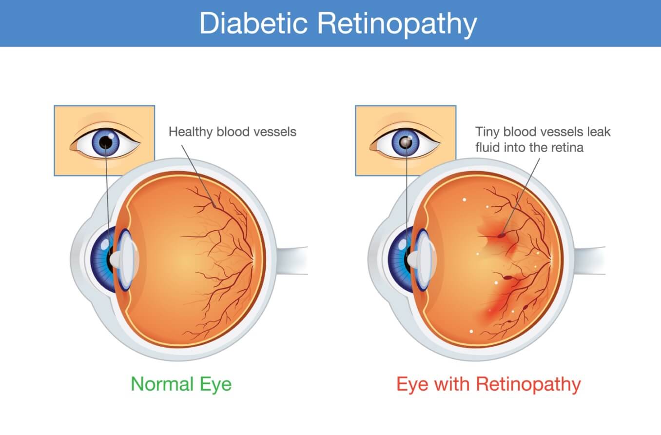 Types of diabetic eye problems