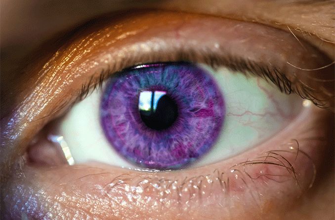 Is there a disease that causes purple eyes?