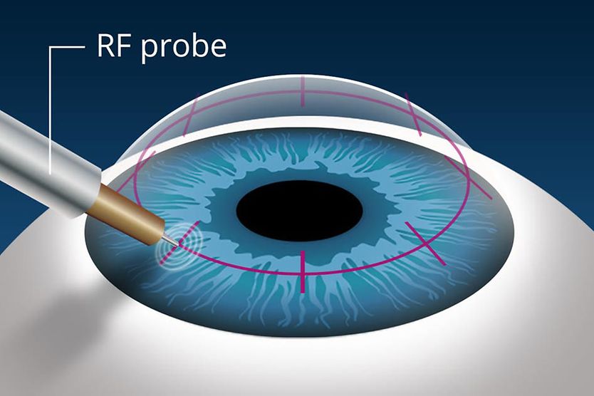 illustration of conductive keratoplasty (CK) surgery for presbyopia