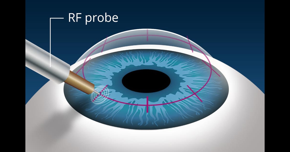 Vision surgery for presbyopia