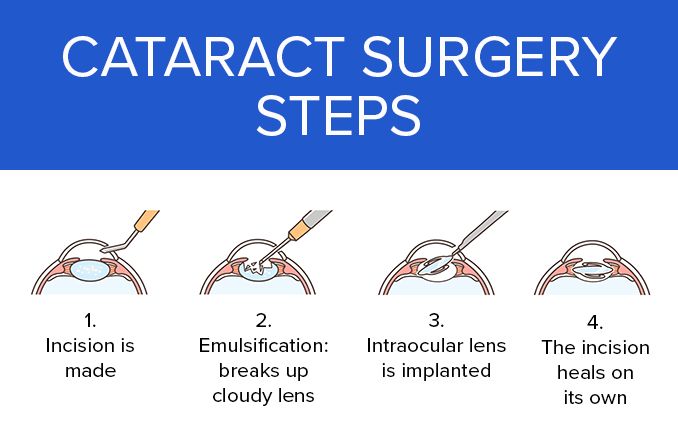 Cataract surgery