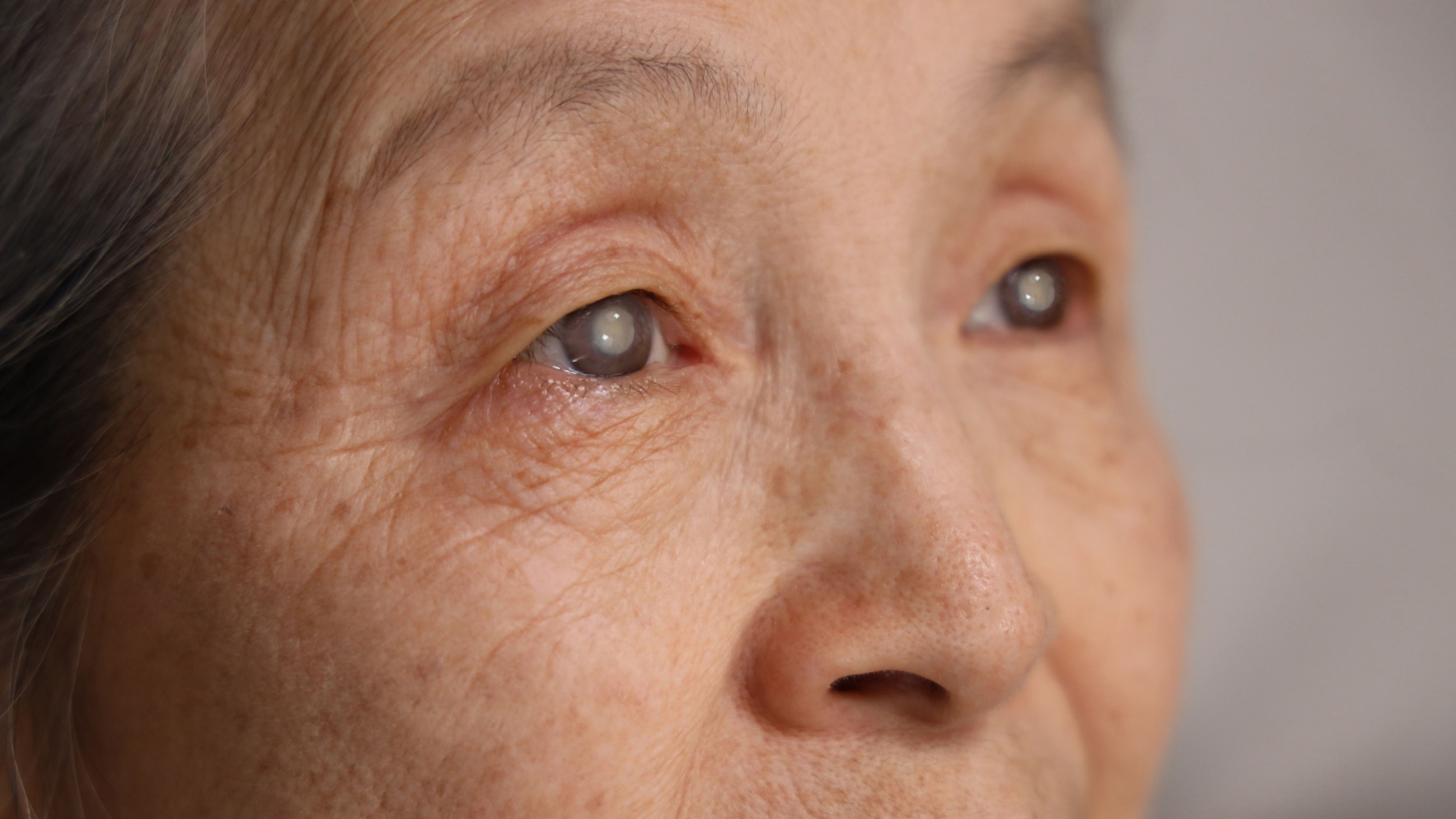 Cataract surgery complications