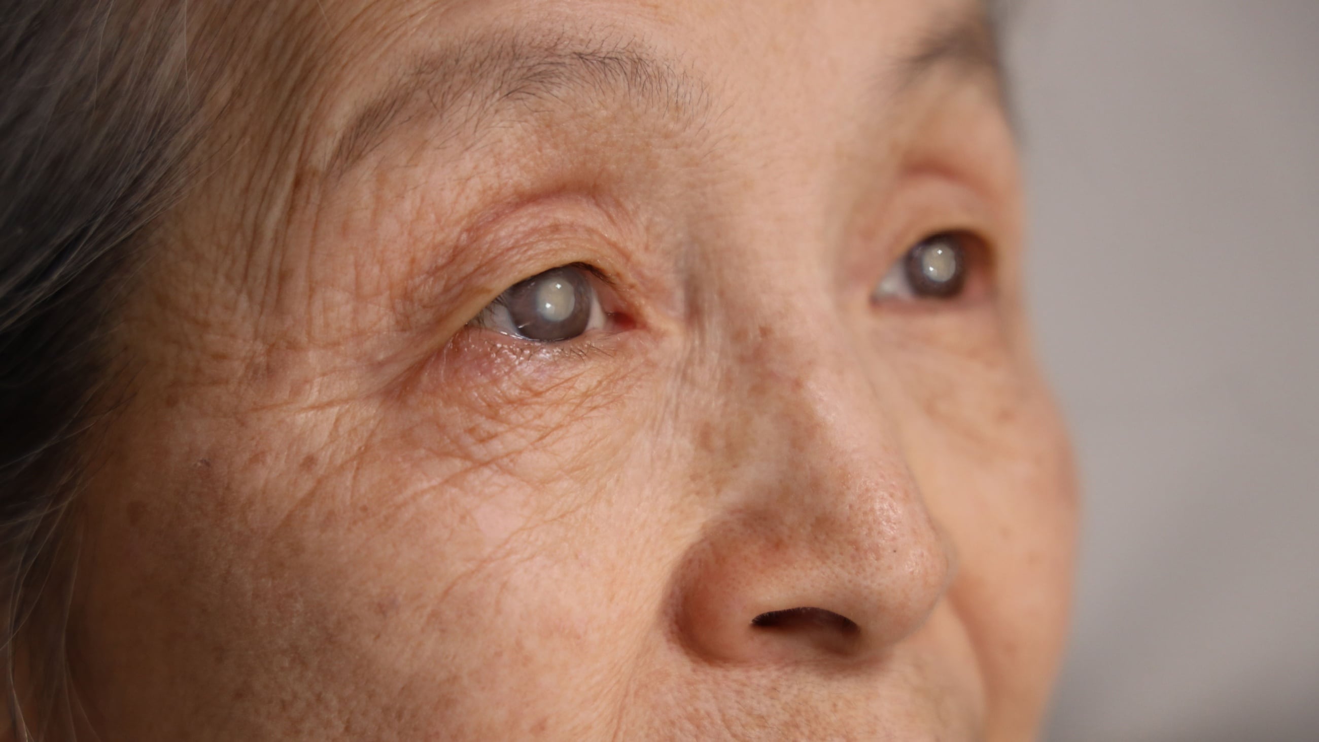 Closeup of an eye with a dense cataract