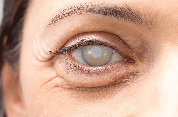 Cataract surgery complications