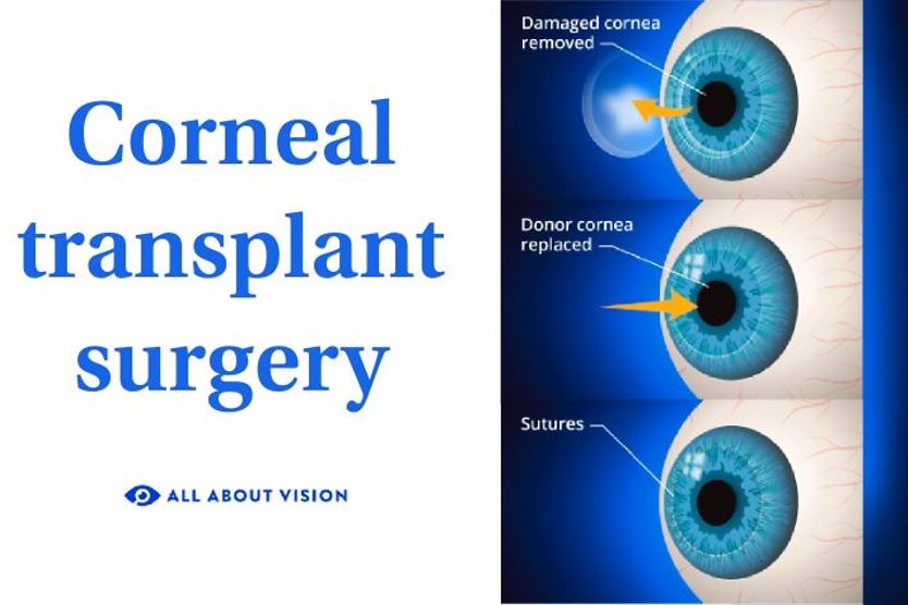cornea transplant illustration cornea transplant illustration