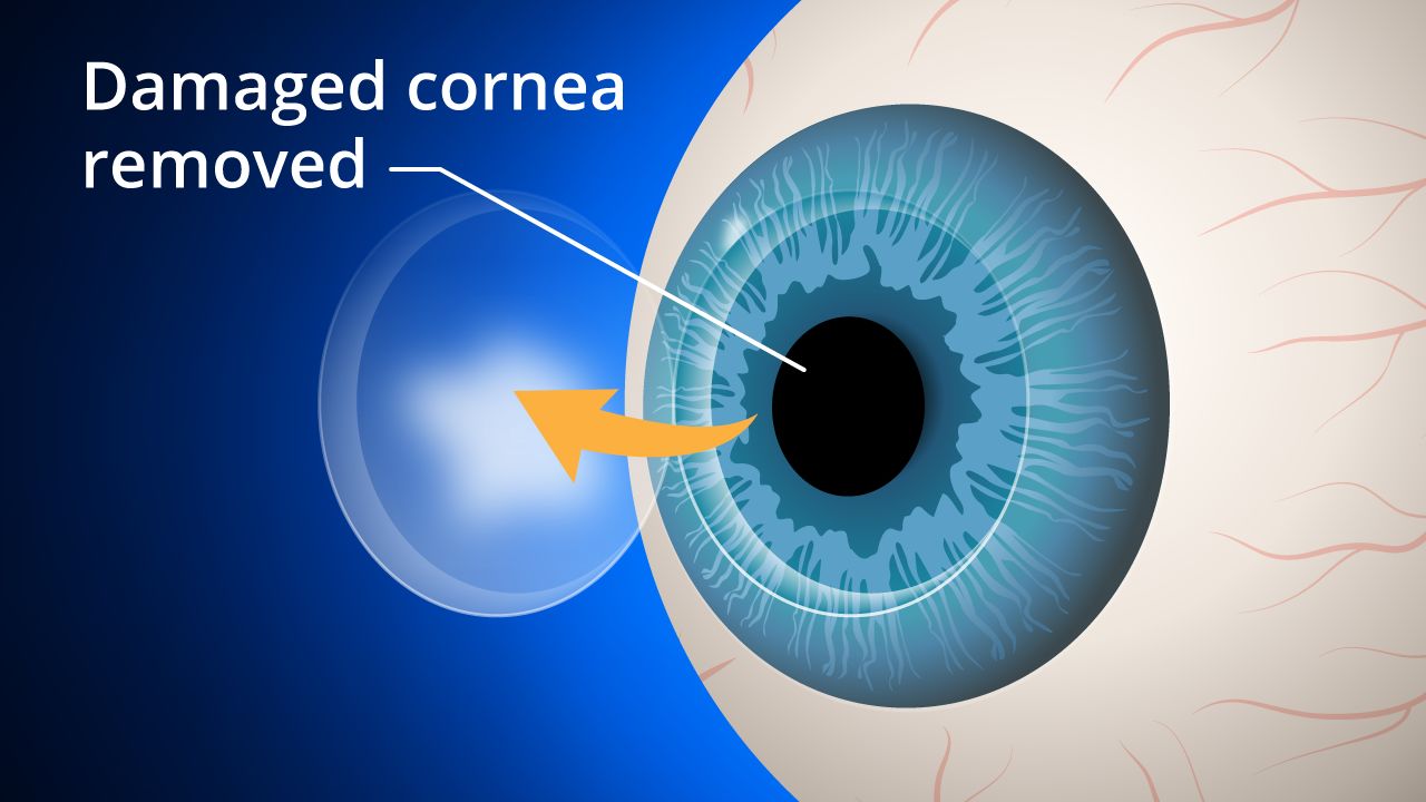 Cornea transplants: What to expect from keratoplasty