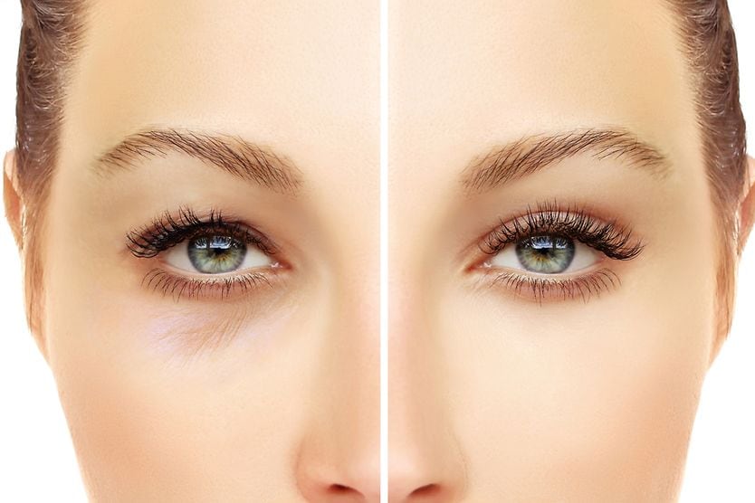 upper and lower eyelid blepharoplasty before and after pics