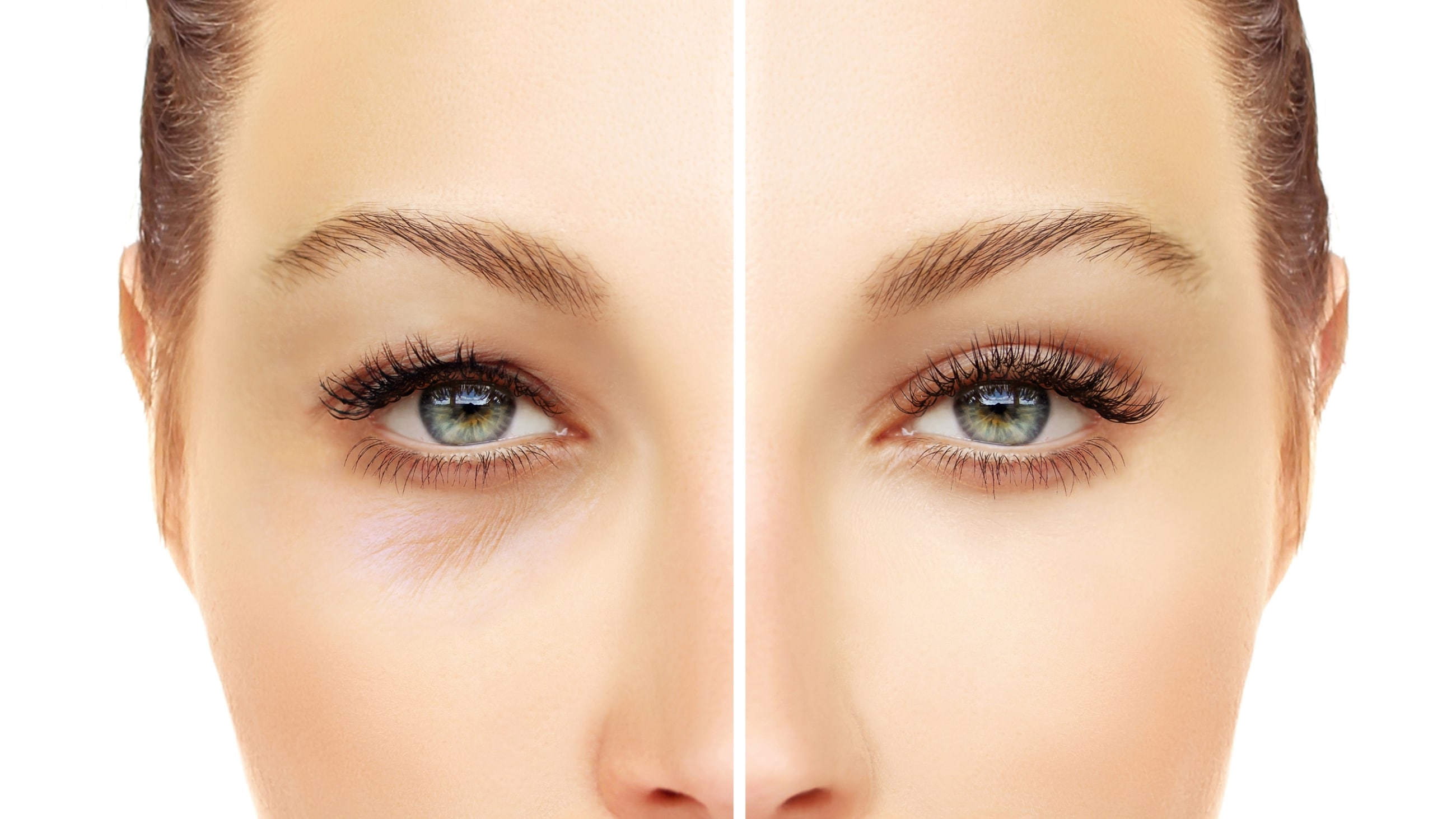Blepharoplasty (Eyelid surgery) Blepharoplasty (Eyelid surgery)