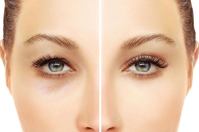 upper and lower eyelid blepharoplasty before and after pics upper and lower eyelid blepharoplasty before and after pics