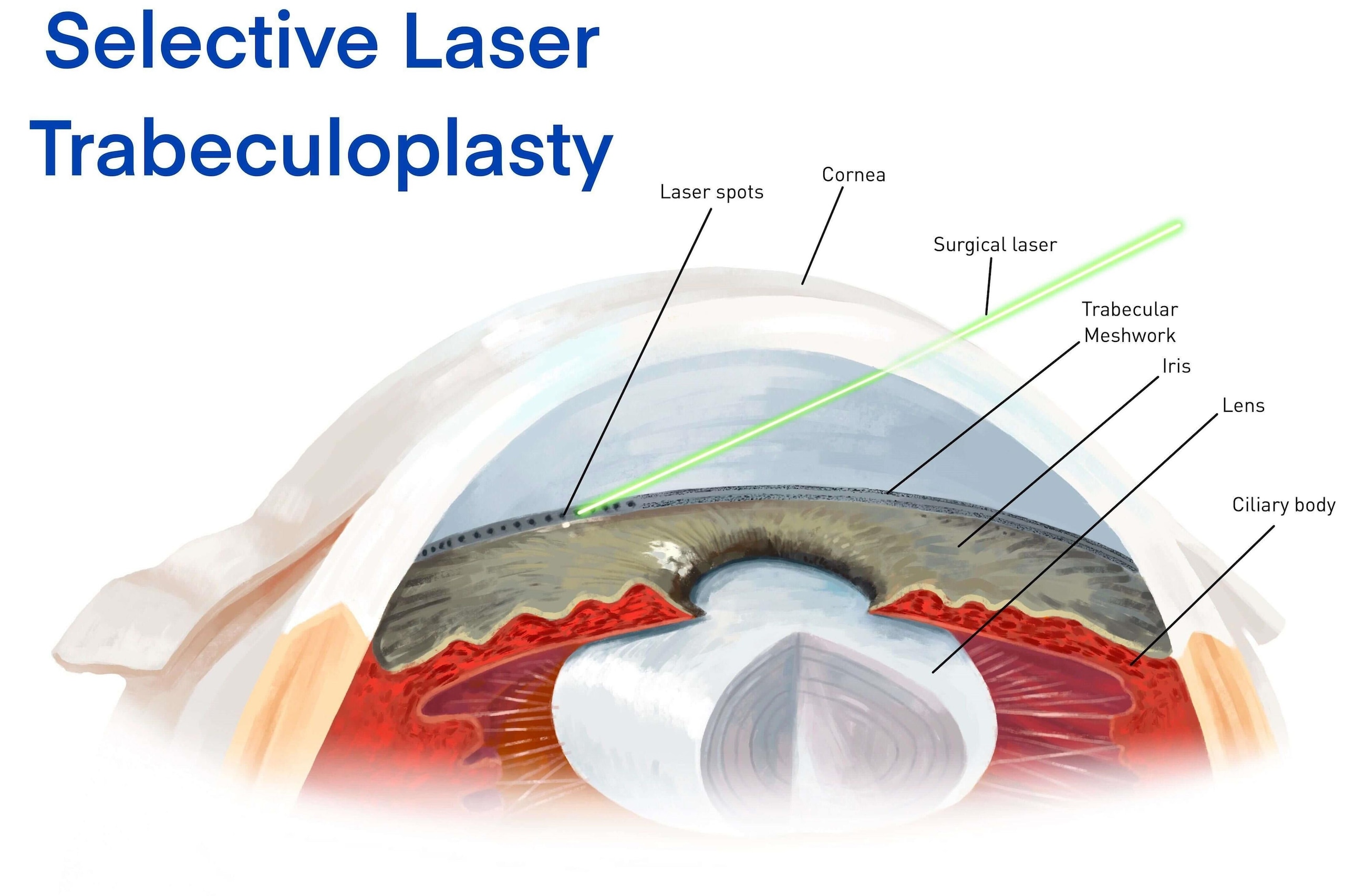 Selective laser trabeculoplasty (SLT)