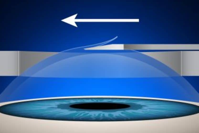 illustration of first step of epi-LASIK procedure