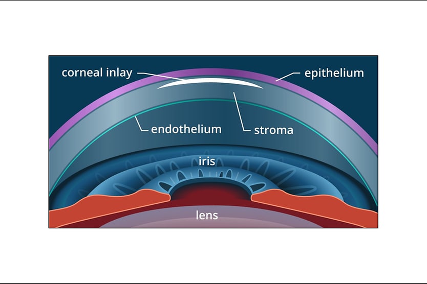 eye with corneal inlay for presbyopia