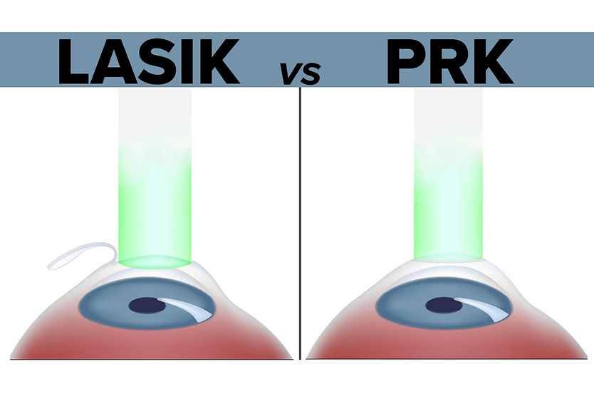 illustration of a lasik surgery procedure vs a prk laser surgery procedure