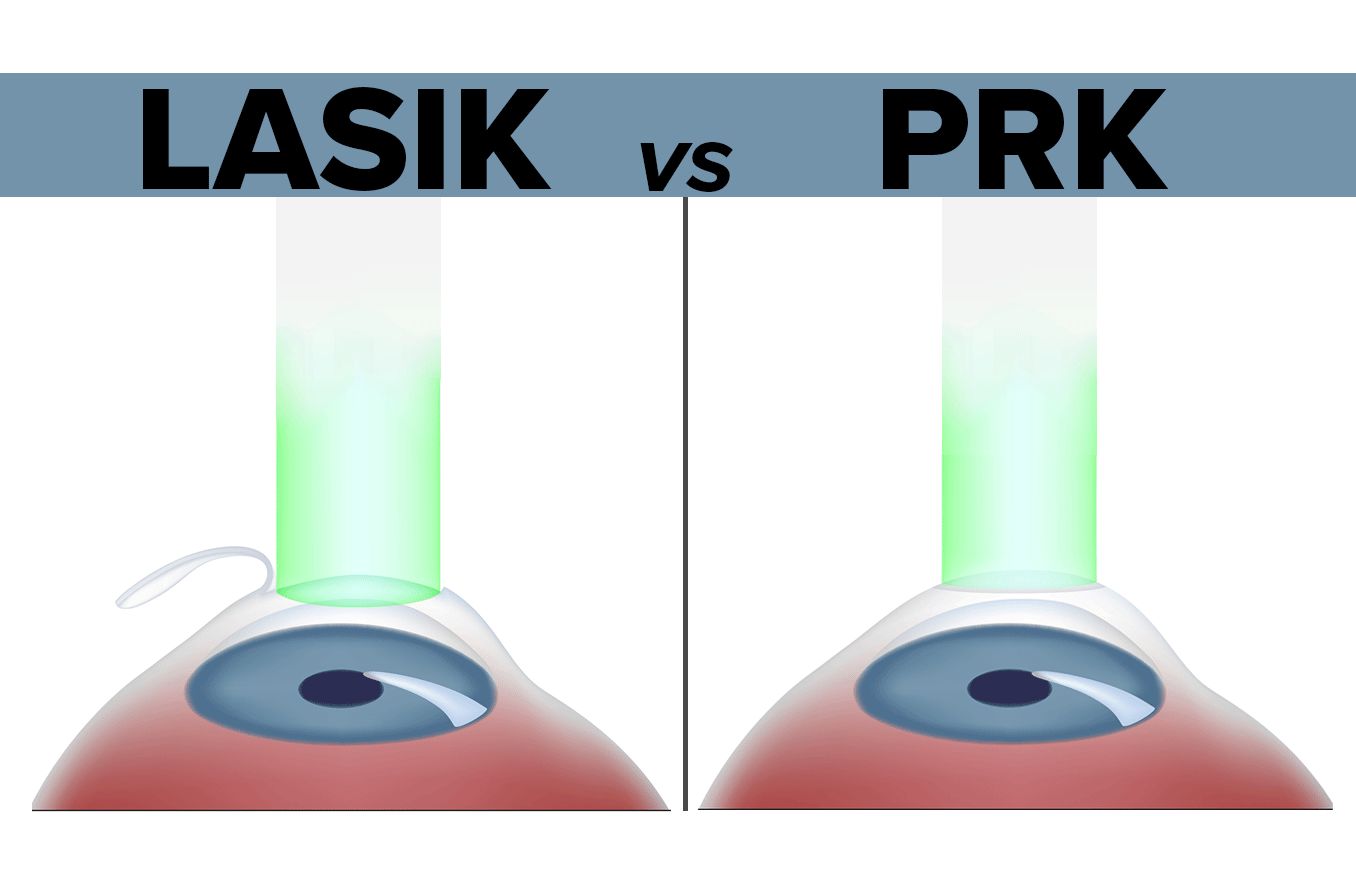 illustration of a lasik surgery procedure vs a prk laser surgery procedure