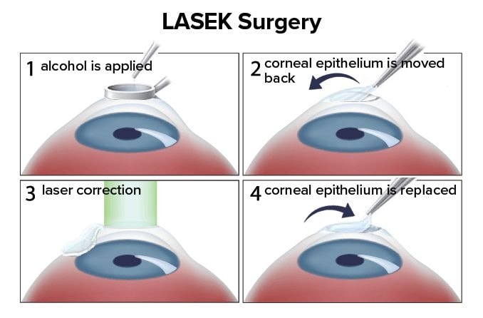 LASEK eye surgery: How it works LASEK eye surgery: How it works