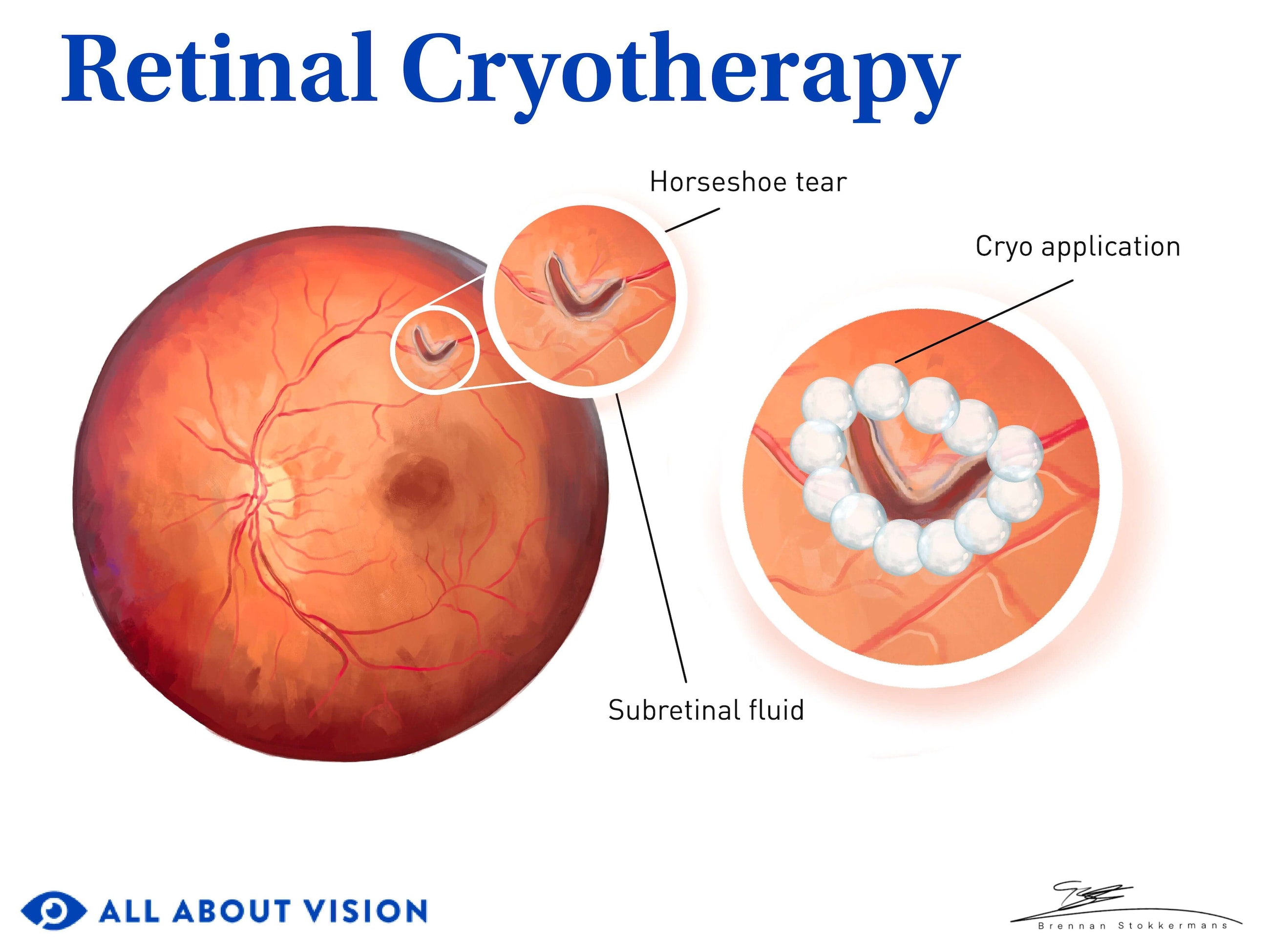 Cryopexy (retinal cryotherapy) Cryopexy (retinal cryotherapy)