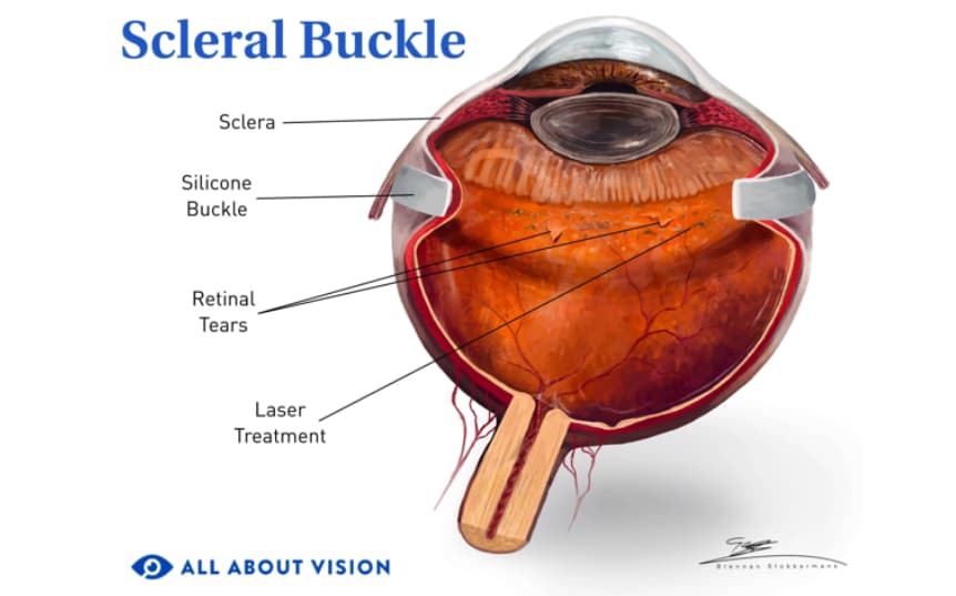 Illustration of elements that make up a scleral buckle