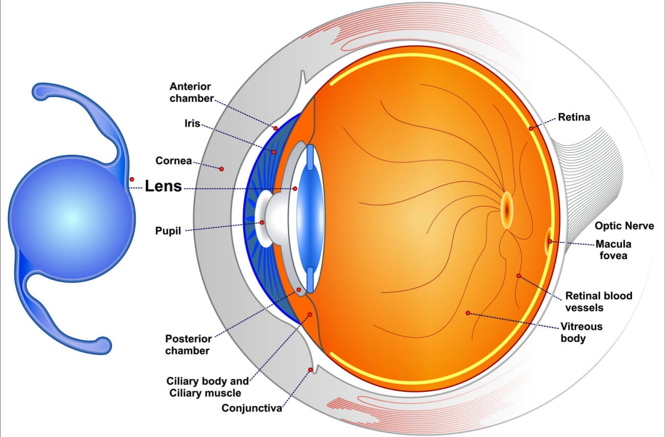 Astigmatism and cataract? A toric IOL can fix both