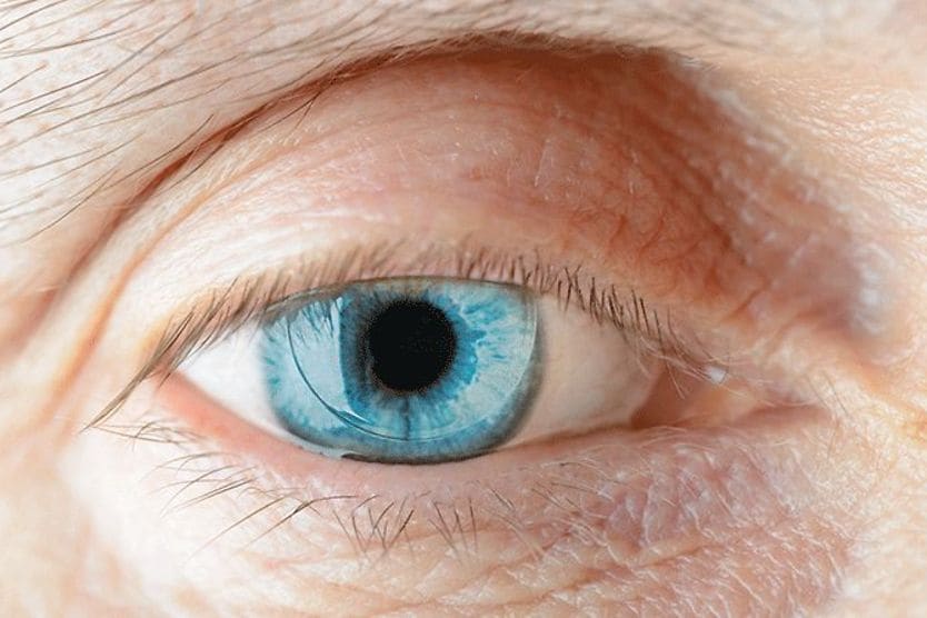 man wearing a PMMA contact lens