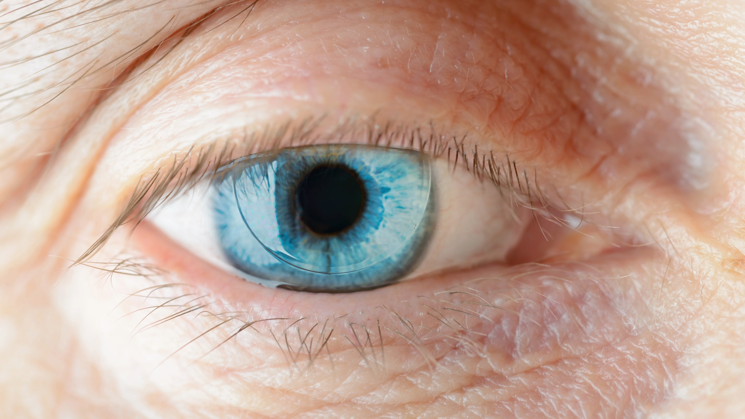 PMMA: A contact lens classic, now in disrepute PMMA: A contact lens classic, now in disrepute