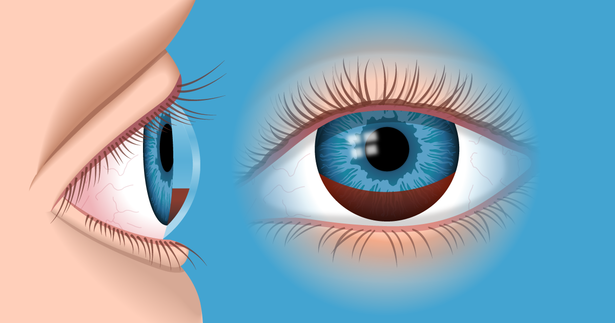 Hyphäma - Ursachen für Blut im Auge | All About Vision