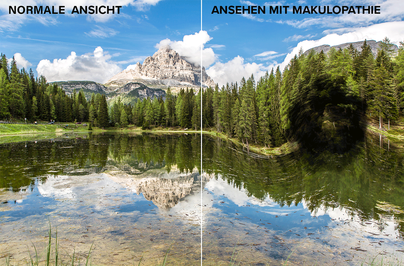 Was ist Makulopathie?