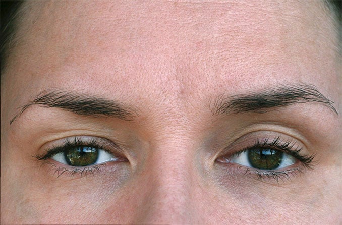 Ptosis (hängendes Augenlid): Ursachen und Behandlung