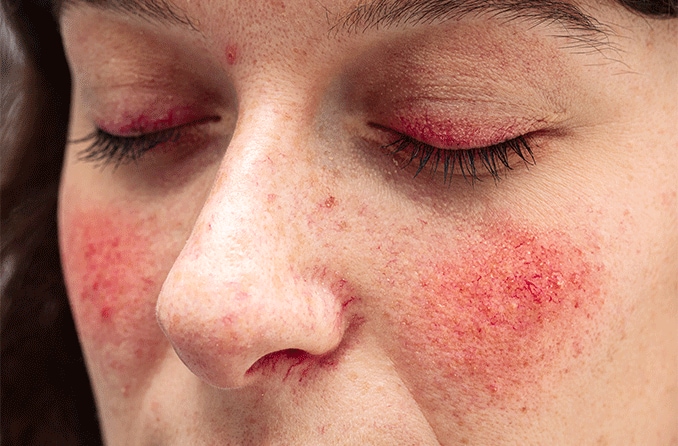 Lidekzem (Liddermatitis): Ursachen, Symptome und Behandlung