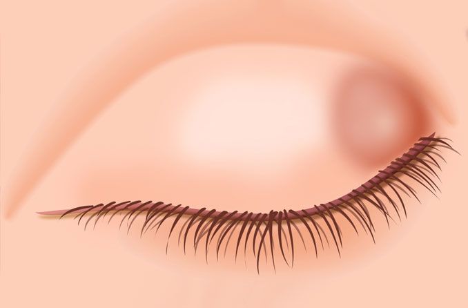 Chalazion: Vorbeugung, Symptome, Ursachen und Behandlung