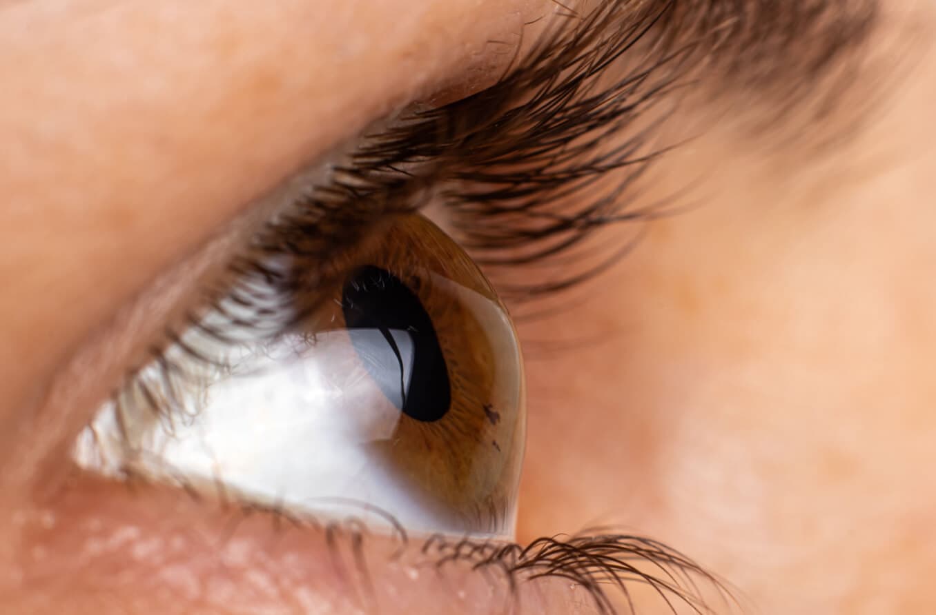 Was sind die Symptome und Behandlungen von Keratokonus?