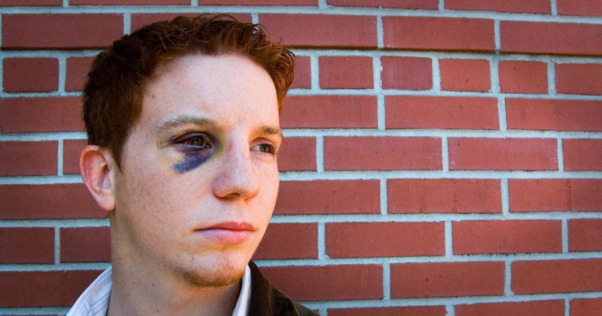 Junge mit einem blauen Auge Junge mit einem blauen Auge