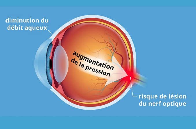 Was verursacht einen erhöhten Augeninnendruck (Okuläre Hypertension)?